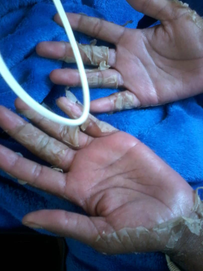 Natasha's hands during illness